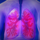 Tubercolosi multiresistente ai farmaci